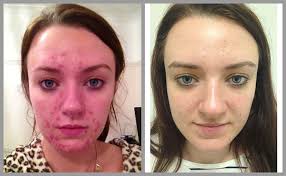 Acne Treatment Results