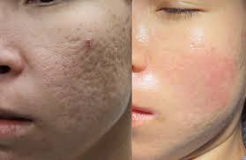 Acne Treatment