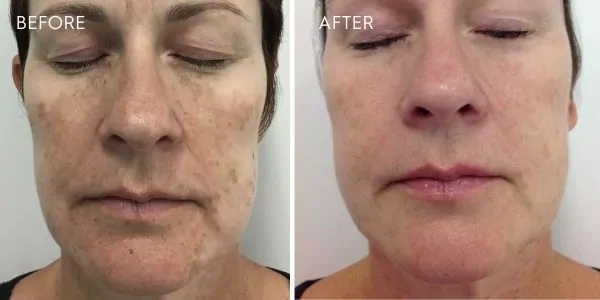 Pigmentation Treatment Results